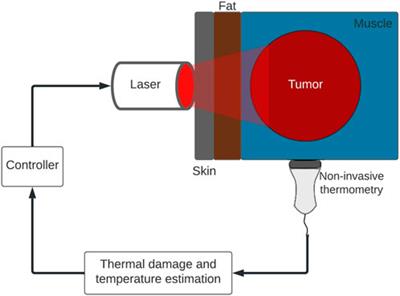 Tissue damage-tracking control system for image-guided photothermal therapy of cancer